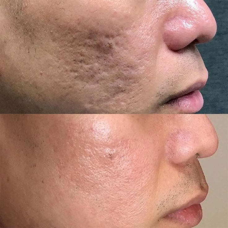Voor- en nabeeld van een CO2-laserbehandeling bij Dutch Skincare (3)